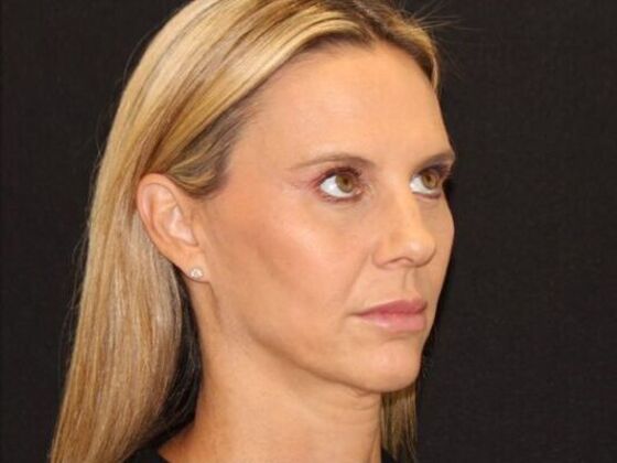 Injectables: Case 98 - After