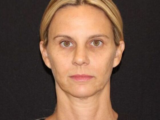 Injectables: Case 98 - Before