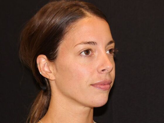 Injectables: Case 99 - After