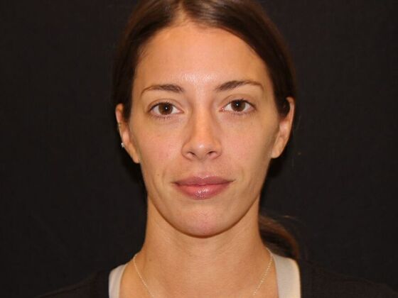 Injectables Case 99 - After