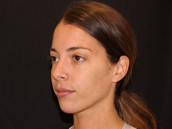 Injectables: Case 99 - After