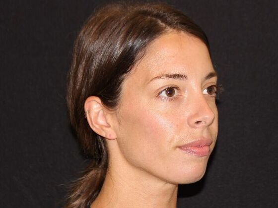 Injectables: Case 99 - Before