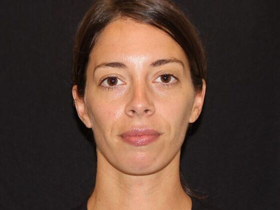 Injectables Case 99 - Before