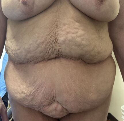 Tummy Tuck (Abdominoplasty): Case 555 - Before