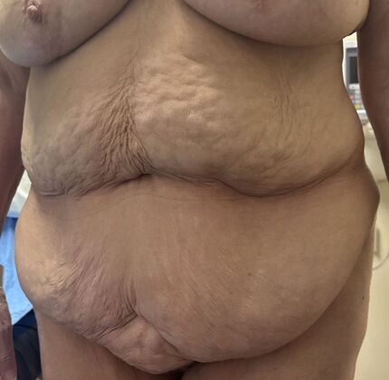 Tummy Tuck (Abdominoplasty): Case 555 - Before