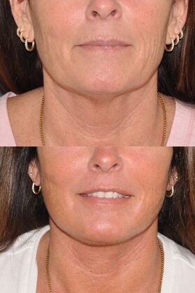 Facelift: Deep plane face and neck lift - Before and after