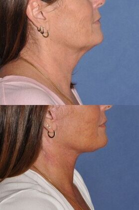 Facelift: Deep plane face and neck lift - Before and after