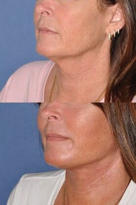 Facelift: Deep plane face and neck lift - Before and after