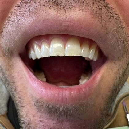 Dental Bonding: Case 5 - Before