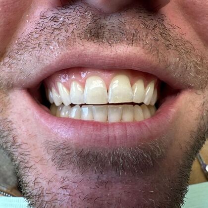 Dental Bonding: Case 5 - After