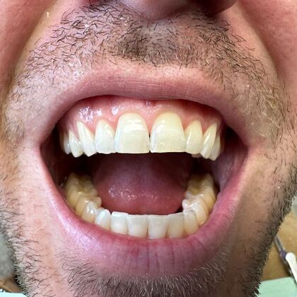 Dental Bonding Case 5 - After