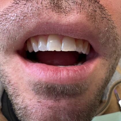 Dental Bonding Case 5 - Before