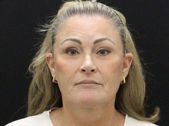 Face & Neck Lifts: Case 51 - After