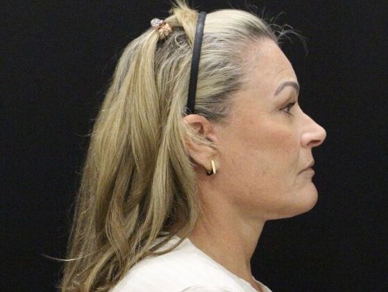 Face & Neck Lifts: Case 51 - After