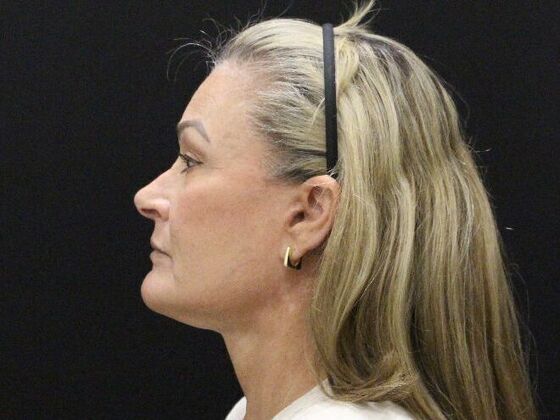 Face & Neck Lifts: Case 51 - After