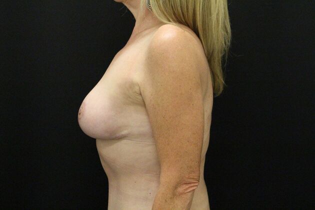 Breast Reduction & Lift: Case 38 - After