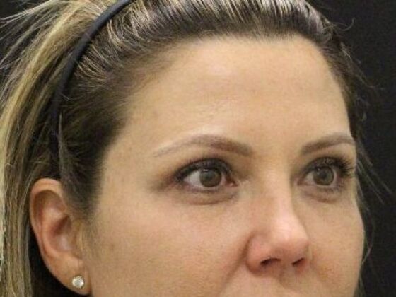 Eyelid Surgery: Case 24 - After