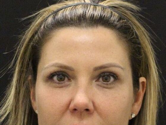 Eyelid Surgery: Case 24 - After