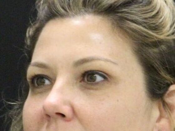 Eyelid Surgery: Case 24 - Before