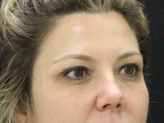 Eyelid Surgery: Case 24 - Before