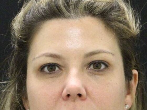 Eyelid Surgery: Case 24 - Before