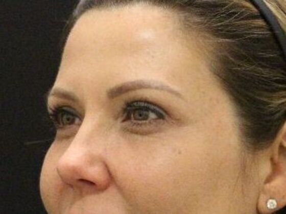 Eyelid Surgery: Case 24 - After