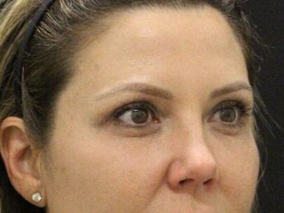 Non-Surgical: Case 18 - After