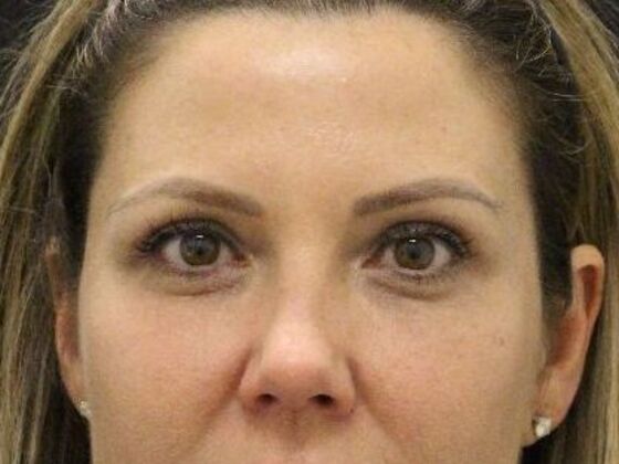 Non-Surgical Case 18 - After