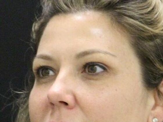 Non-Surgical: Case 18 - Before