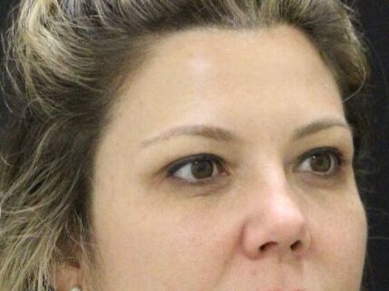 Non-Surgical: Case 18 - Before