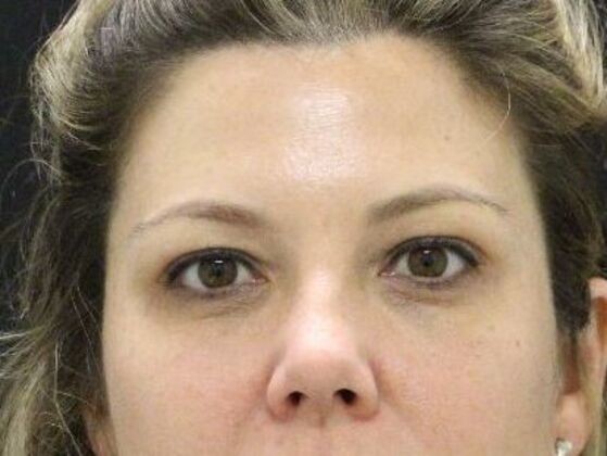 Non-Surgical Case 18 - Before