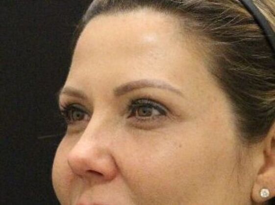 Non-Surgical: Case 18 - After