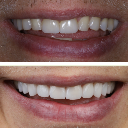 Minimal Prep Porcelain Veneers Luis - Before