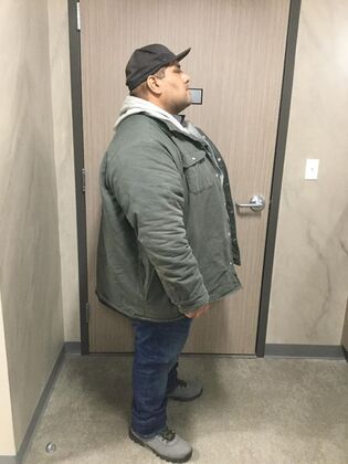 Gastric Sleeve: Case 12 - Before