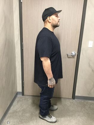 Gastric Sleeve: Case 12 - After