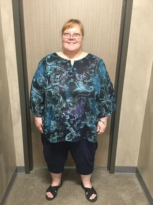 Gastric Sleeve Case 13 - Before