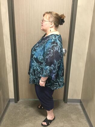 Gastric Sleeve: Case 13 - Before