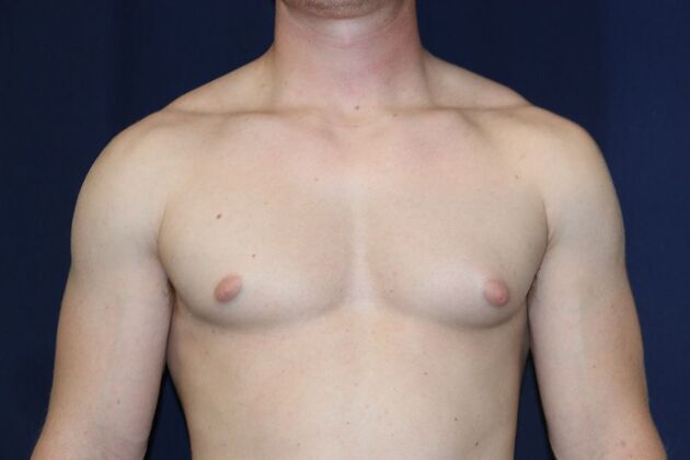 Male Breast Reduction* Case 11 - Before