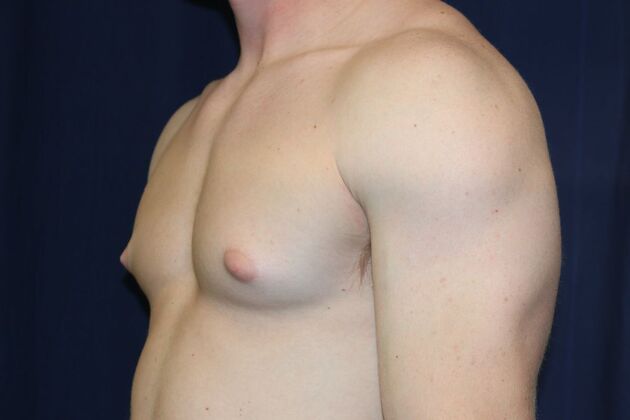 Male Breast Reduction*: Case 11 - Before