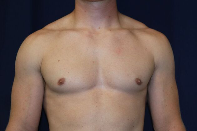 Male Breast Reduction* Case 11 - After