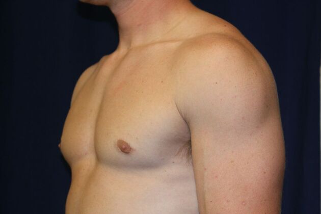 Male Breast Reduction*: Case 11 - After