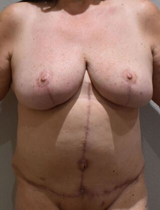 Mommy Makeover Case 350 - After