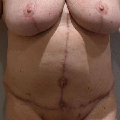 Tummy Tuck (Abdominoplasty) Case 556 - After
