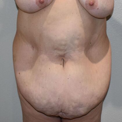 Tummy Tuck (Abdominoplasty) Case 556 - Before
