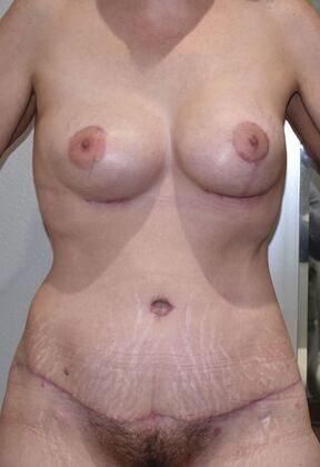 Mommy Makeover Case 351 - After