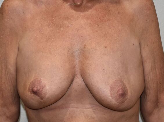 Breast Augmentation w/ Lift Case 619 - Before