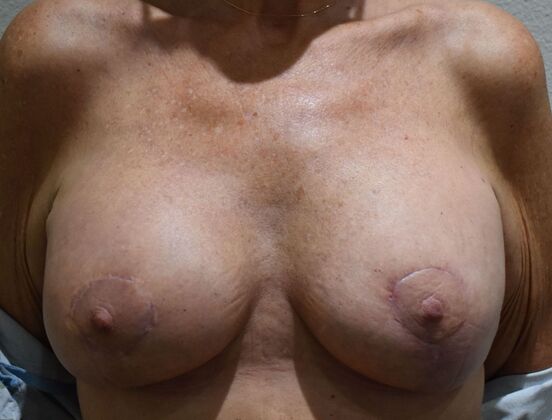 Breast Augmentation w/ Lift Case 619 - After