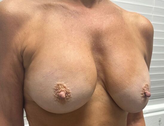Breast Revision: Case 317 - Before