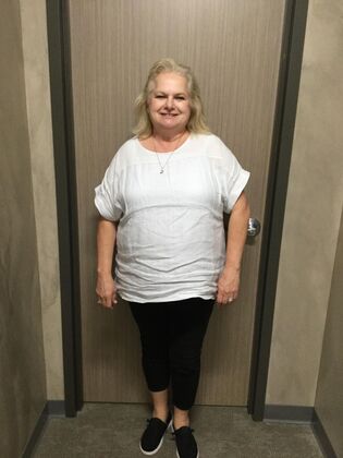 Laparoscopic Gastric Bypass Case 8 - Before