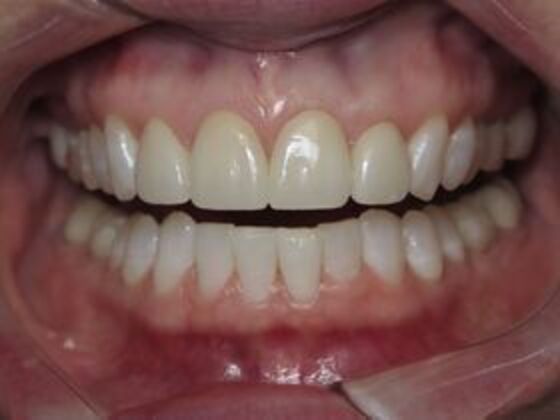 Veneers Case 4 - After